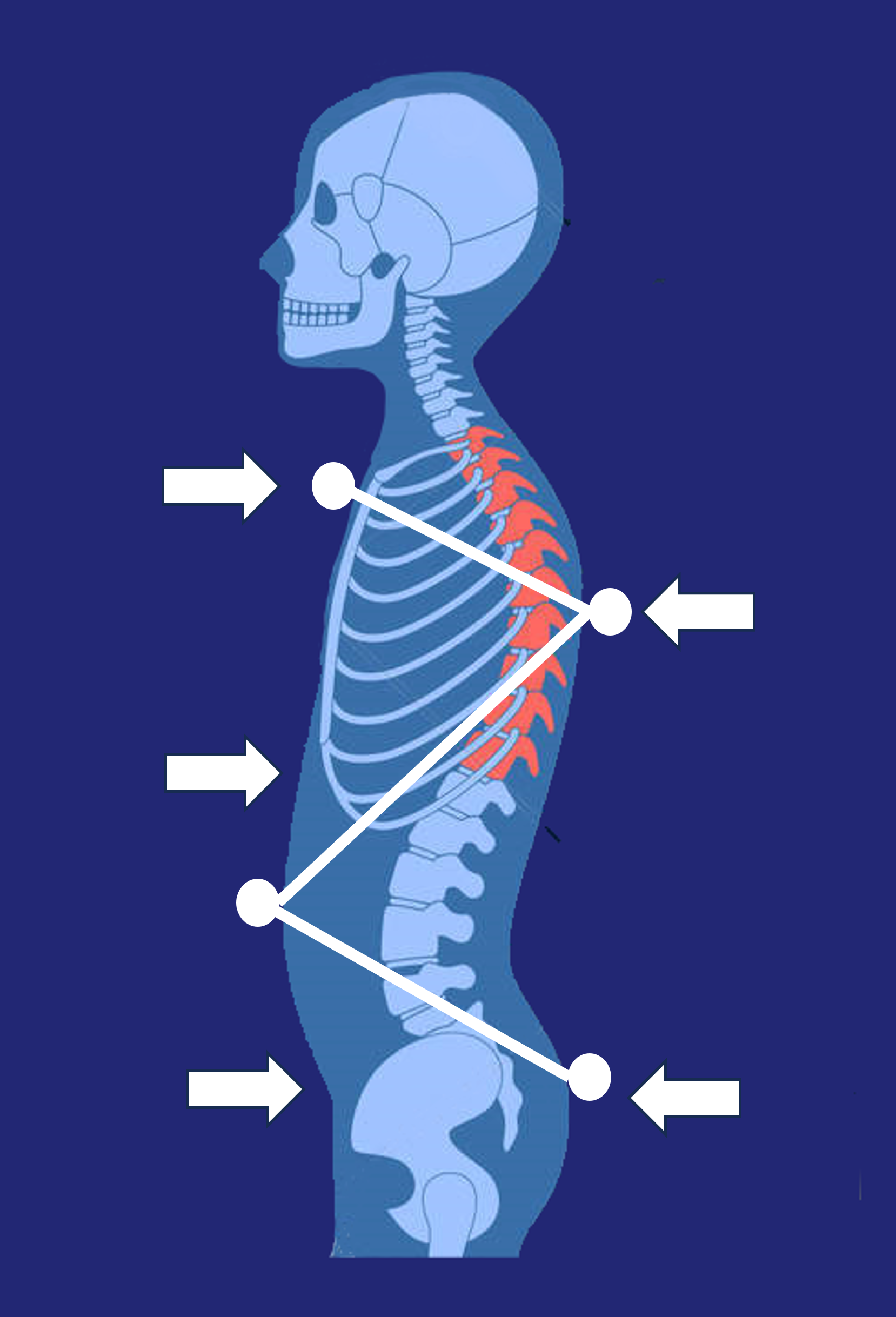 Cifosis - IGM Ortopedia